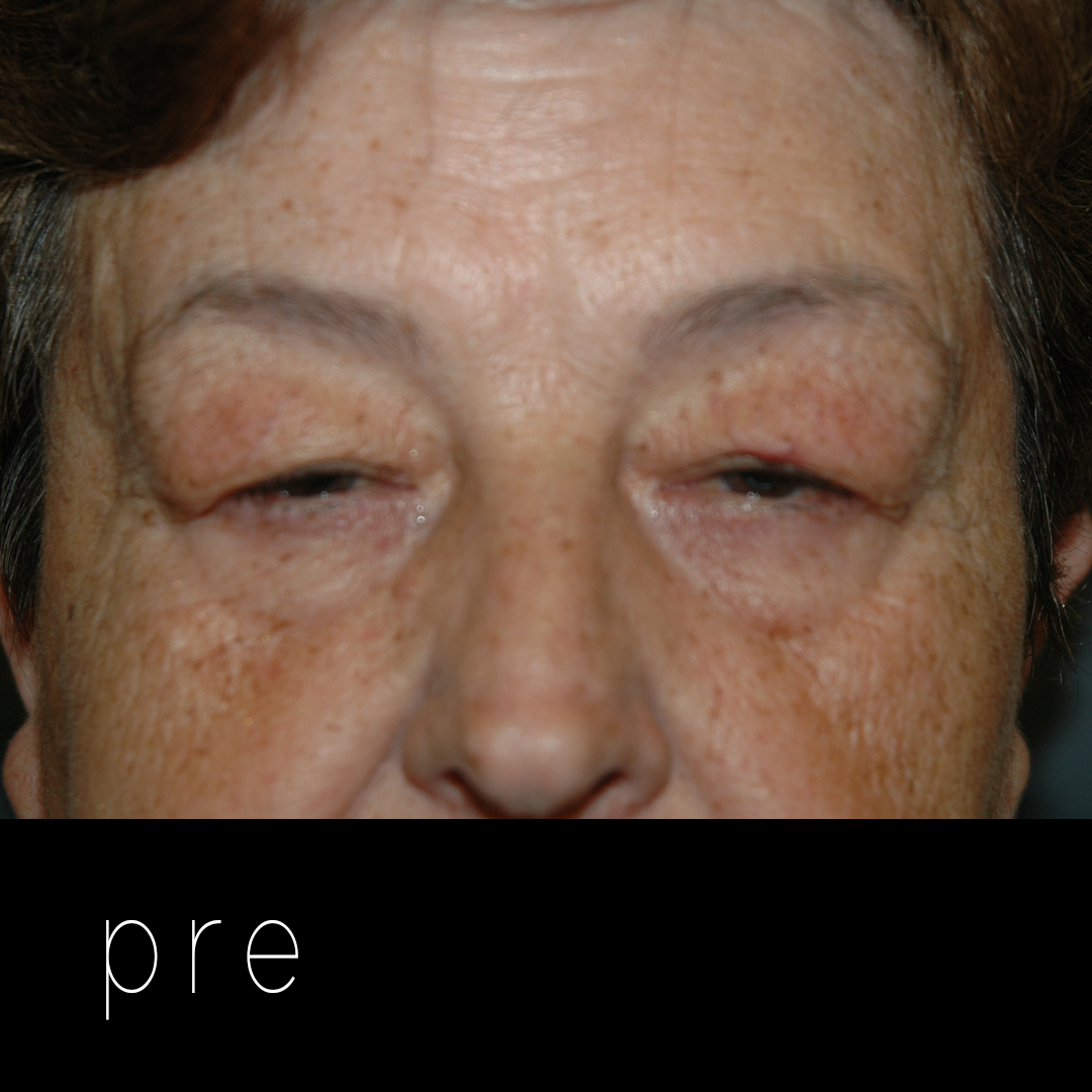 DERMATOCALASIA: párpados caídos por exceso de piel.