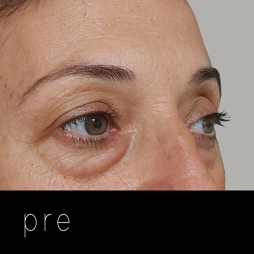 BLEFAROPLBLEFAROPLASTIA: laxitud septal.ASTIA pre