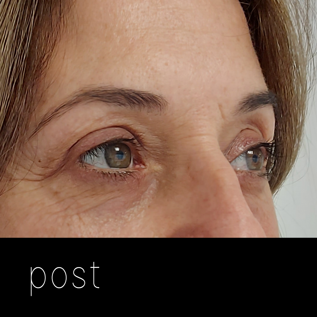 BLEFAROPLASTBLEFAROPLASTIA: tensado de párpado inferior + corrección de ptosis mecánica.IA post