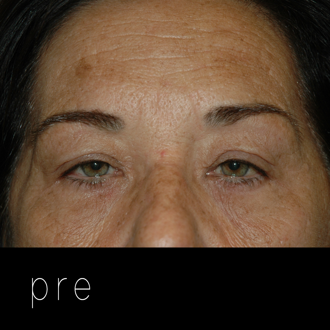 PTOSIS + BLEFARO: dermatocalasia que condiciona párpados caídos.