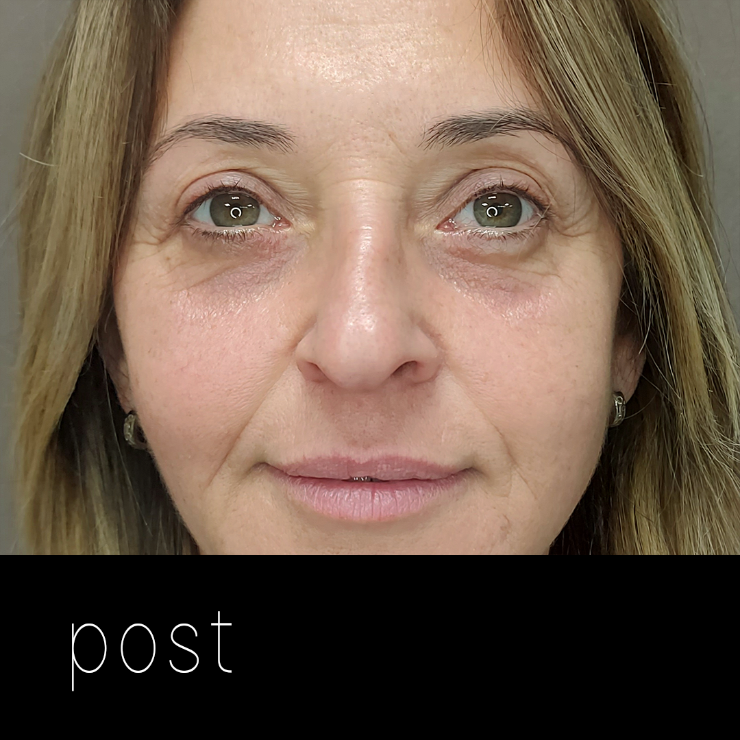 BLEFAROBLEFAROPLASTIA: tensado de párpado inferior + corrección de ptosis mecánica.PLASTIA post