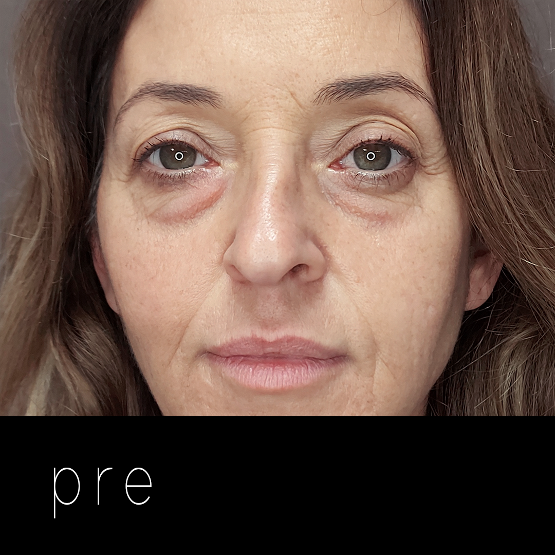 BLEFAROPLASTIA: laxitud septal.