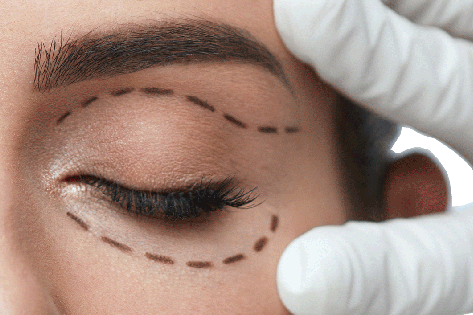 blefaroplastia