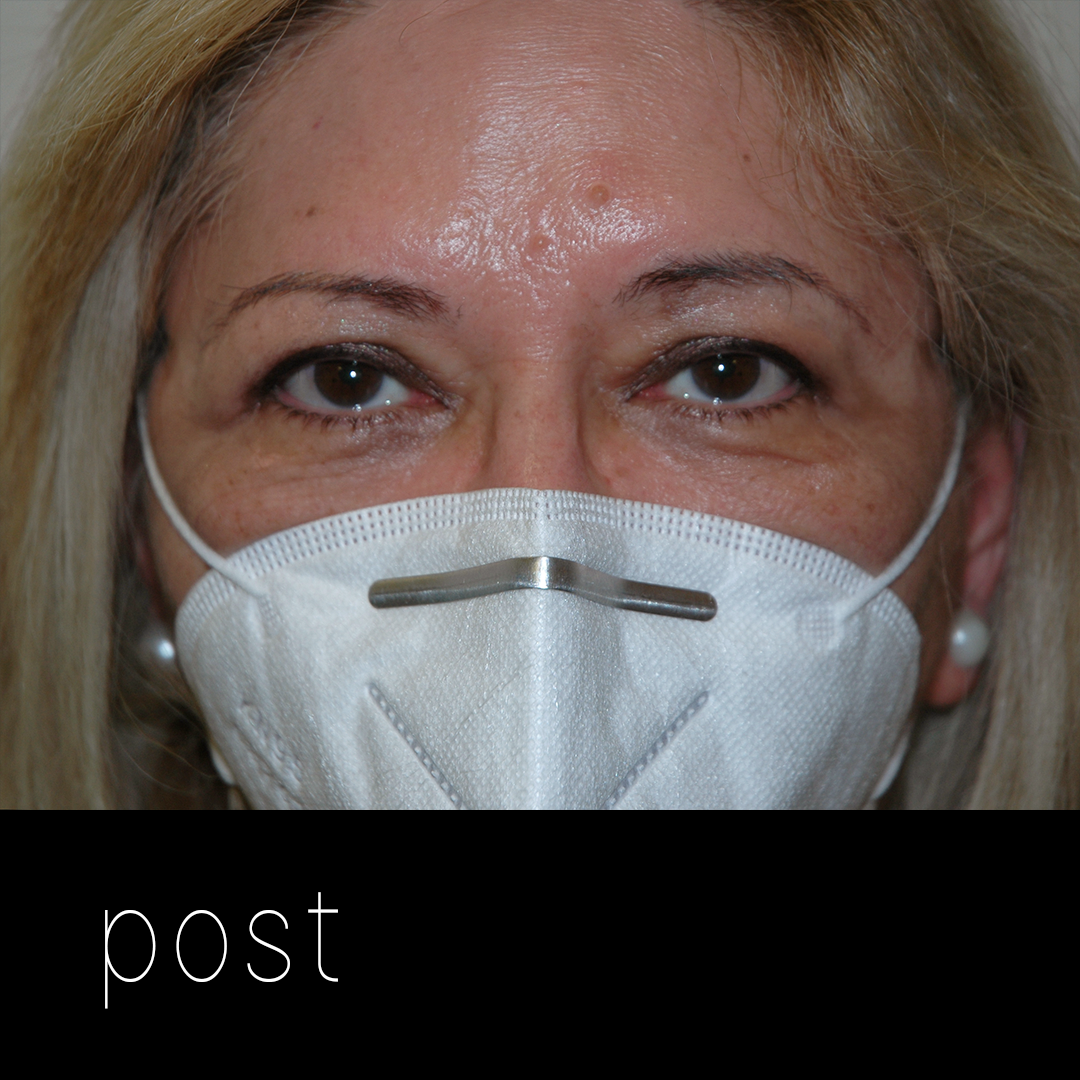 BLEFAROPLASTIA: aspecto tras elevación de cejas, resección de piel y reposición de glándulas en fosas lagrimales orbitarias.