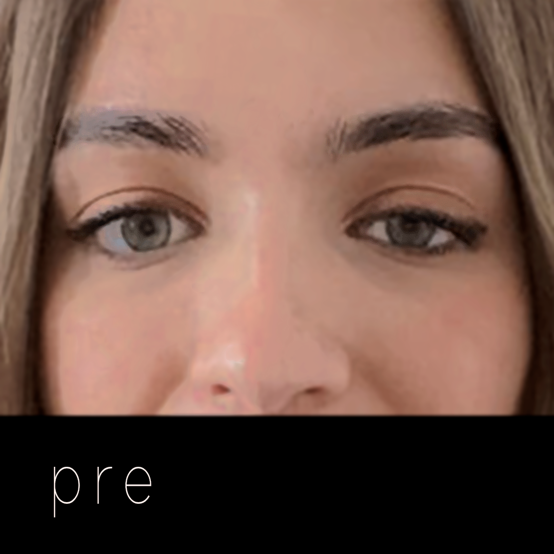 PTOSIS: párpado caído.