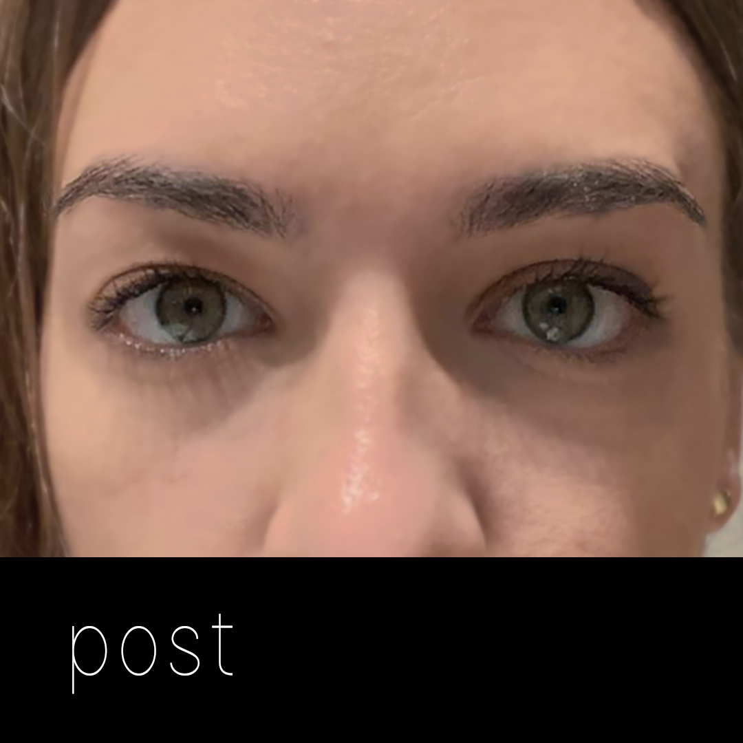 PTOSIS: elevación del párpado con cirugía vía posterior (transconjuntival) sin cicatriz.