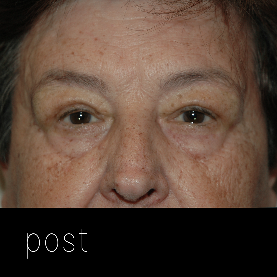 DERMATOCALASIA: cirugía de elevación + blefaroplastia superior.