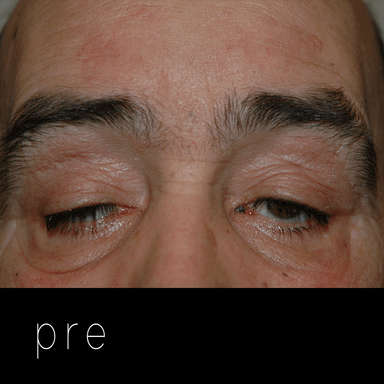 Cirugía de párpados