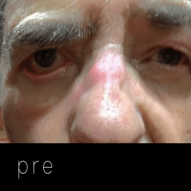 Cirugía de párpados