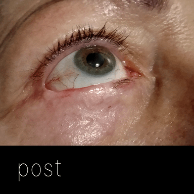 Cirugía de párpados