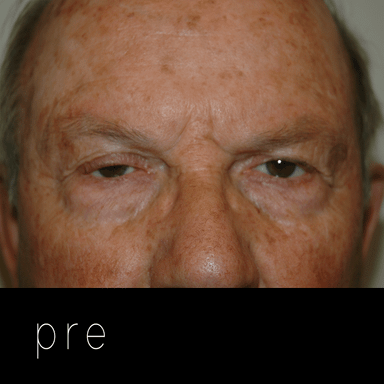 Cirugía de párpados