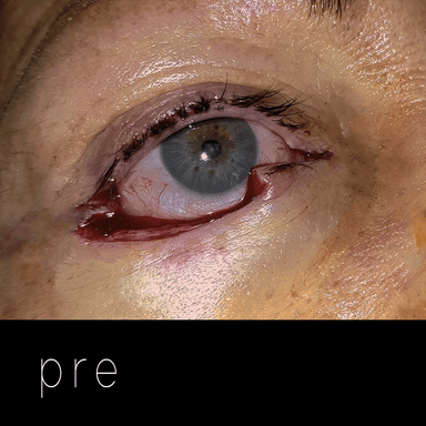 Cirugía de párpados