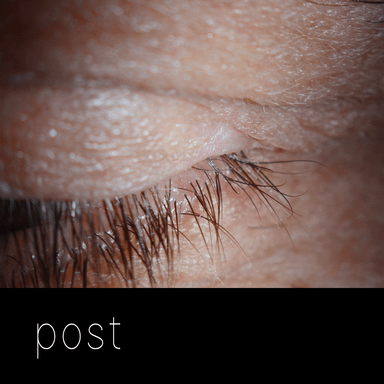 Cirugía de párpados