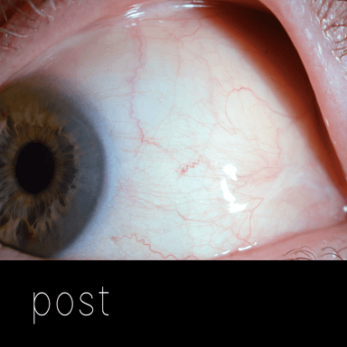 Cirugía de párpados