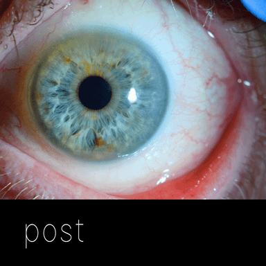 Cirugía de párpados