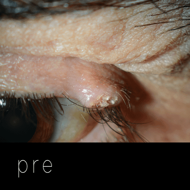 Cirugía de párpados